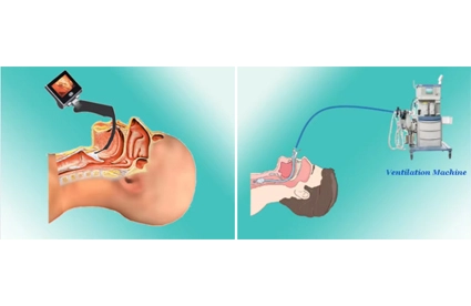 How Long Does A Laryngoscopy Take Under General Anesthesia?