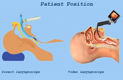 Advantages of the Videolaryngoscope Compared to The Direct Laryngoscope