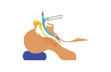 Why to Choose Haiye Fiber Optic Laryngoscopes for Intubation？